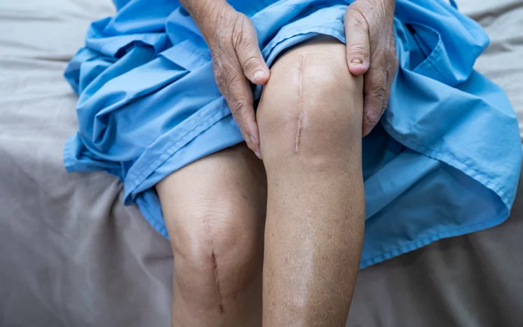 Partial Knee Replacement Surgery in Goa