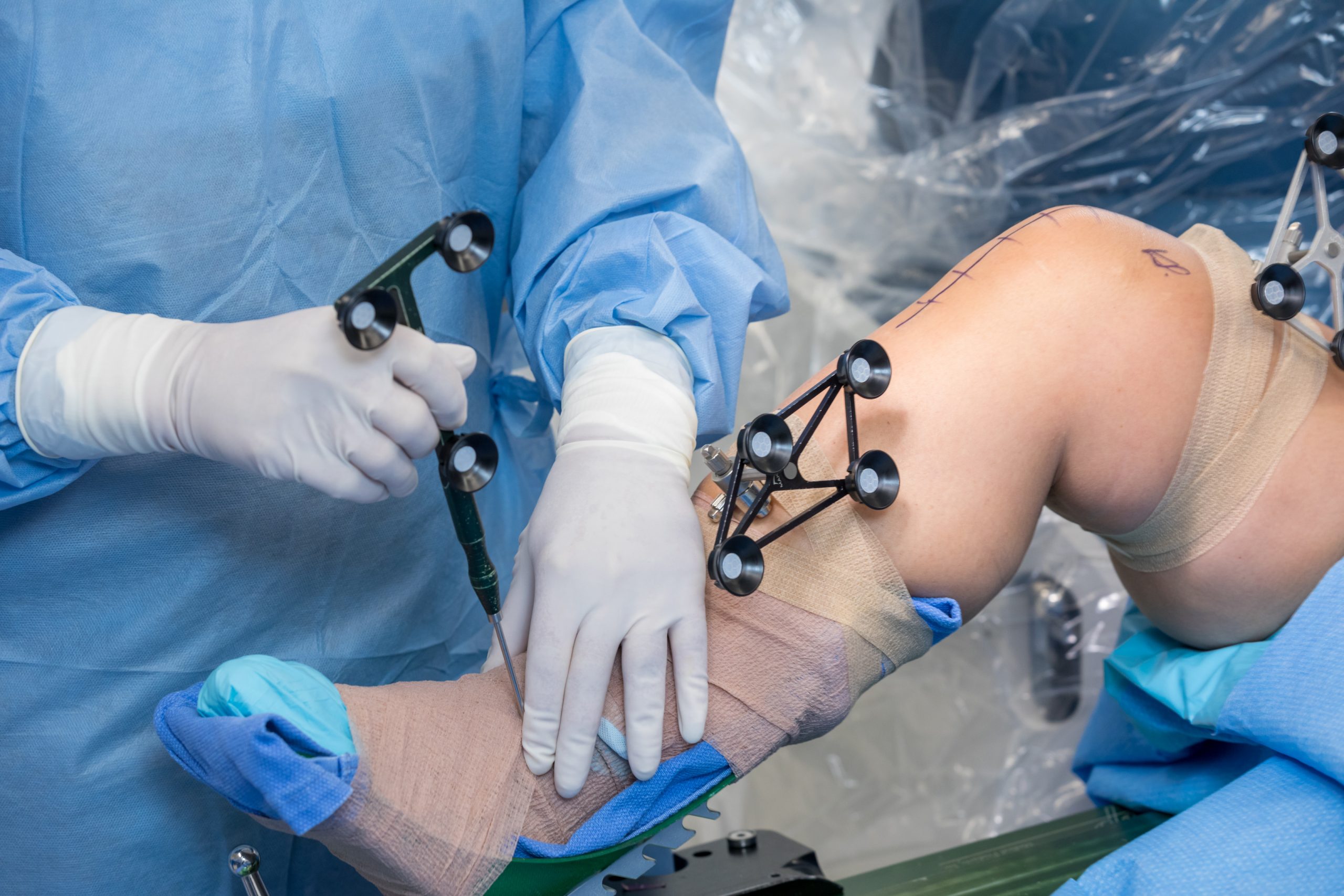 Robotic knee replacement in Goa