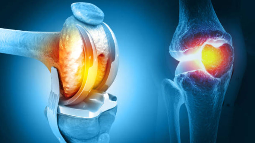 Knee Replacement Surgery Goa for Severe Arthritis and Knee Damage