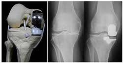 Partial Knee Replacement in Goa: Advanced Minimally Invasive Techniques